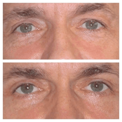 Best Eye bag removal Surgeon in dubai: The Consultation Process